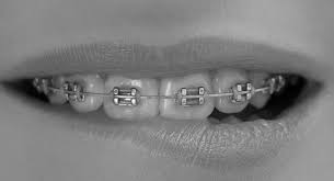 How many days can i stay in south africa without needing to extend my. How Much Do Braces Cost In South Africa 2021 Goodbear