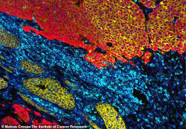 There are four major factors that influence one's risk for developing this risk is further increased if the cancer was diagnosed at a younger age (less than 55 years of age) or affected three or more family members. A New Urine Test Can Detect An Aggressive Form Of Prostate Cancer That Is Missed By As Many As 1 In 5 Scans Ali2day