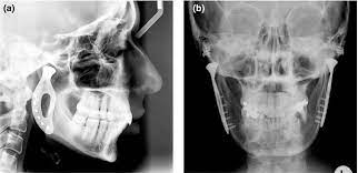 A 'slipped' (prolapsed) disc often causes sudden, severe lower back pain. Management Of Temporomandibular Joint Disorders A Surgeon S Perspective Dimitroulis 2018 Australian Dental Journal Wiley Online Library