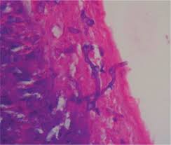 Mucormycosis is a rare, severe infection with fungi of the order mucorales. Mucormicosis Gastrointestinal En Paciente Diabetico Reporte De Un Caso Y Revision De La Literatura Sciencedirect