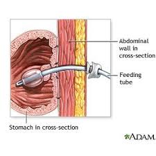 Percutaneous Endoscopic Gastrostomy Insertion Inpatient Care What You Need To Know