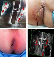 Image result for Perirectal Abscess