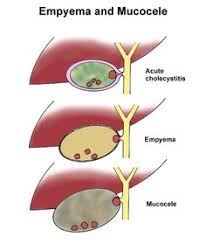Surgeons may remove your gallbladder (called a cholecystectomy) if gallstones (or other types of. 14 Gallbladder Hydrops Ideas Gallbladder Biliary Colic Gallbladder Symptoms