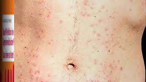 Akute Hiv Infektion Youtube