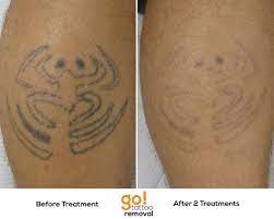 Stick And Poke Tattoos Almost Always Come Out Quickly Averaging Just 2 5 Treatments For Full Removal This One Will Lik Tattoo Removal Tattoos Homemade Tattoos