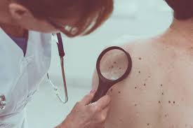 Cancer is the ultimate killer: Melanoma Skin Cancer May Be Detected Early With Blood Test Study Finds Allure