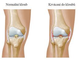 Jsme si povídali s ortopedem radovanem kubešem z nemocnice na bulovce. Vrozena Krvacivost Hemofilie Priznaky Priciny A Lecba Rehabilitace Info