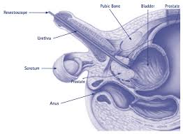 Take steps to avoid infection, such as washing your for one thing, stress is difficult to define. Laser Prostatectomy Our Services Urology Bay Of Plenty