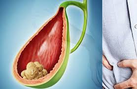 Check spelling or type a new query. Criza De Bila Simptome Cauze Tratament Si Remedii Naturiste Lataifas