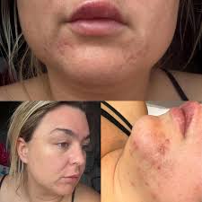 Amazing Results 👌🏼 Just one chemical peel and look at this  transformation—only 3 days later! Jess came to me looking for help with her  skin. We discussed her home care routine, lifestyle,