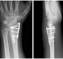 Management of Intra-Articular Distal Radius Fractures: Volar ...
