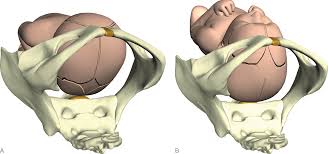 The baby is head down, facing the spine, with its back anterior. Normal Labor And Delivery Chapter 2 Obstetric Interventions