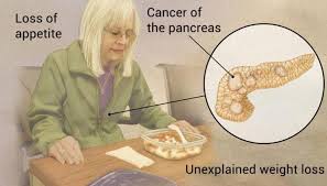 .was diagnosed with stage iv pancreatic adenocarcinoma on oct 3, 2017, with a primary tumor in the tail of the pancreas and several liver lesions. Stage 4 Pancreatic Cancer Life Expectancy Canceroz