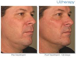 Ultherapy does not involve most of these cost elements. Ultherapy Skin Tightening Saratoga Springs Albany Ny