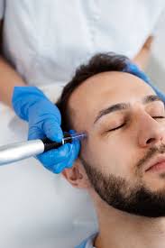 Microneedling