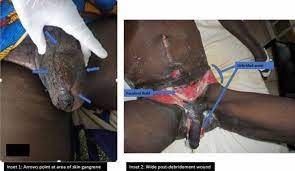 Diabetic gangrene foot rot diabetes gangrene arterial ulcer foot drop arterial occlusive disease drop foot foot gangrene footdrop sugar foot. Fournier S Gangrene A Retrospective Review Of Management Outcomes And Seasonal Variations Of Clinical Presentation African Journal Of Urology Full Text