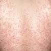 Pityriasis alba is a common, benign skin disorder occurring predominantly in children and adolescents. 1