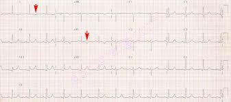 Ecg should be repeated at predetermined intervals or if symptoms return. Acute Non St Elevation Nstemi High Lateral Myocardial Infarction Due To Diagonal Artery Obstruction Ekg Ecg Diyarbakir Kardiyoloji Kalp Hastaliklari Mete Alpaslan Doktorekg Com Doctorecg Com