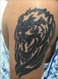 Answer each question to discover the temporary tattoo that matches your personality. Red Scaly Rash Following Tattoo Application Mdedge Dermatology