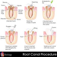 This is the part of a tooth's anatomy most impacted by a root canal. What Is Root Canal Treatment Orion S Dental