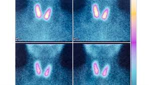 In exceptionally rare cases, papillary thyroid tumors may assume enormous dimensions. The Diagnostic Work Up Of Thyroid Nodules Ruling Out Papillary Thyroid Cancer Endocrinology Advisor