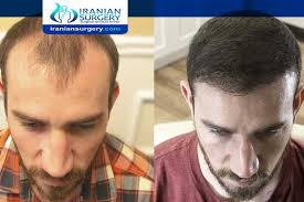 Beard hair transplant to head. Sex After Hair Transplant Can We Do Sex After Hair Transplant Review