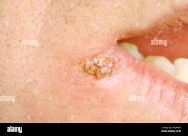 Image result for verrucae filiformes