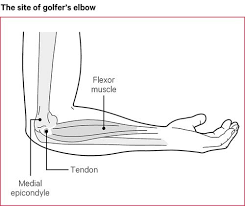 Golfer's elbow is similar to tennis elbow and isn't confined to golfers. Elbow Pain Causes Exercise Treatments Versus Arthritis