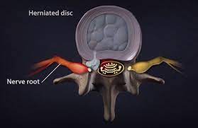 Check spelling or type a new query. The Difference Between Herniated And Bulging Discs Beacon Orthopaedics