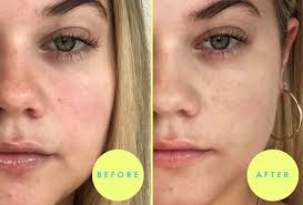 This will provide the skin with optimal moisture. Private Label Tiger Grass Color Correcting Treatment Acne Moisturizing Repair Redness Blemish Face Cream For Rosacea Buy Pimples And Dark Spot Remover Cream Face Cream For Acne Blemish Removal Cream Product On Alibaba Com