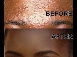 How to get clear skin fast at home? Remove Dark Spots In Just 2 Days 100 Natural Skincare Youtube