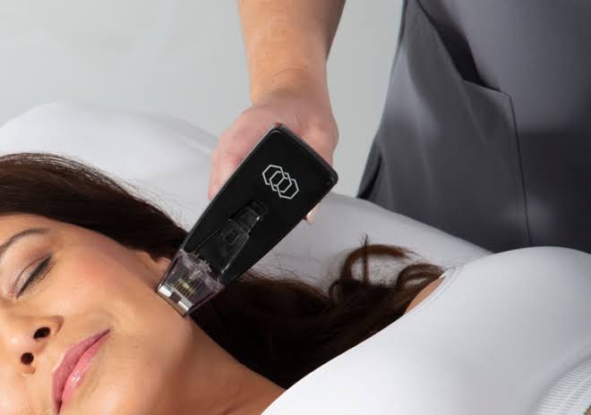 Morpheus8 Winnipeg | Advanced Acne Scar Treatments