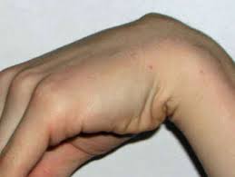 Uberbein Ganglion An Der Hand Operation Sinnvoll Gesundheit