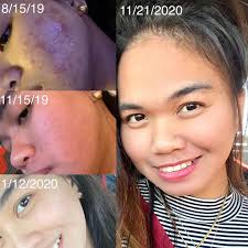 Another lovely skin transformation! 🤩😊✨ This beautiful young lady began  getting hormonal acne which quickly turned into cystic acne. The first  photo