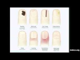 The disease comes from latin origins meaning beneath the nail or claw. Nail Health Could Help Identify Cancer Lagu Mp3 Mp3 Dragon