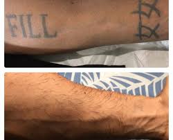 Before and after photos of laser tattoo removal. Laser Tattoo Removal Before And After Results In 2019 Renude Laser