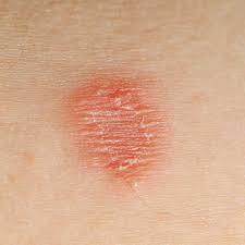 Citalopram Rash Pictures Citalopram Feeling Weird
