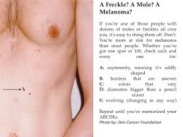The condition is easily treatable. Would You Know Skin Cancer If You Saw It