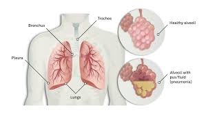 Image result for Pneumonia