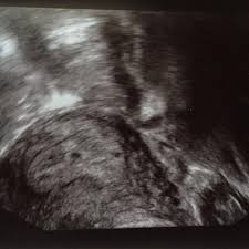 Bekomme Ich Zwillinge Oder Eins Kinder Schwangerschaft Baby