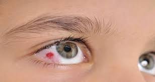 Konjunktivit Belirtileri Tedavisi Istanbul Retina Enstitusu