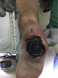 Eschar may cover a wound bed in a thick layer, like a scab. Debridement An Overview Sciencedirect Topics