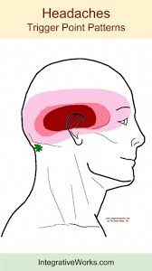 Neck Ache Headache Eye Ache Integrative Works Trigger Points Natural Headache Remedies Headache