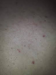 Pickel Auf Brust Gesundheit Und Medizin Haut