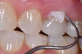 We did not find results for: Developing A System To Eliminate Cementation Failures