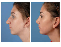 Rhinoplasty What To Expect Before And After A Nose Job