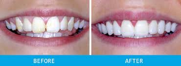Braces can be painful due to wires poking the side of your mouth and soreness from the braces rubbing against the sensitive tissue inside your mouth. How To Get Straight Teeth Without Braces