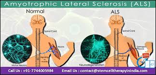 Als, or amyotrophic lateral sclerosis, is a progressive neurodegenerative disease that affects nerve cells in the brain and the spinal cord. Stemcelltherapyforals Amyotrophic Lateral Sclerosis Is Best Treatments Available In India Get Amyotrophic Lateral Sclerosis Stem Cell Therapy Cell Therapy