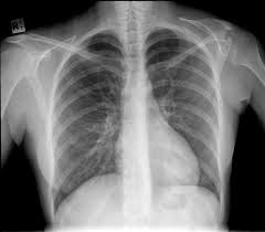 Sprengel Deformity Radiology Case Radiopaedia Org Radiology Radiology Humor Radiology Nursing
