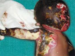 Sulfamylon liquid (5% soln) for wetting heavily contaminated meshed skin grafts or excised but not grafted areas (not for eschar) penetrates eschar, significantly reduces pseudomonas. Jaypeedigital Ebook Reader